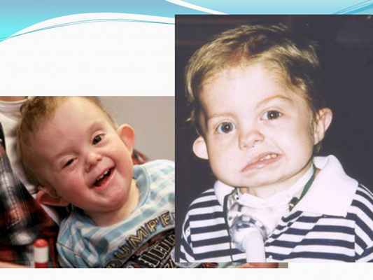 Презентация - Синдром CHARGE (Холла-Хитнера)