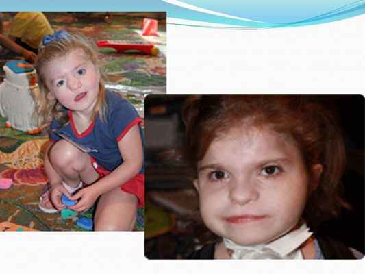 Презентация - Синдром CHARGE (Холла-Хитнера)