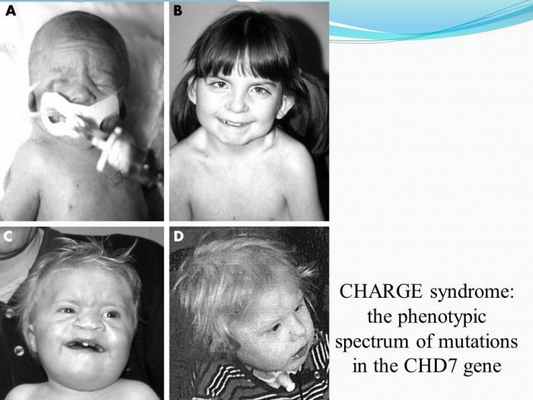 Презентация - Синдром CHARGE (Холла-Хитнера)