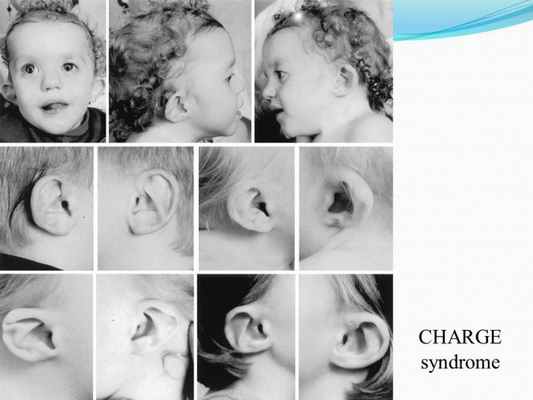 Презентация - Синдром CHARGE (Холла-Хитнера)