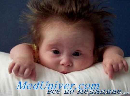 синдром Дауна