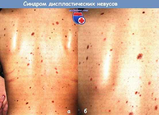 Синдром диспластических невусов