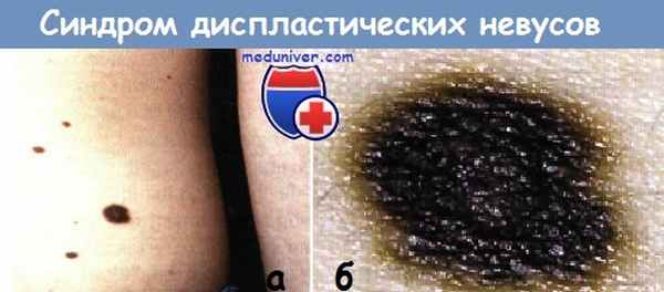 Синдром диспластических невусов
