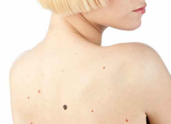 Меланома — злокачественная опухоль