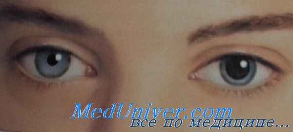 Синдром Эдди (Эйди)