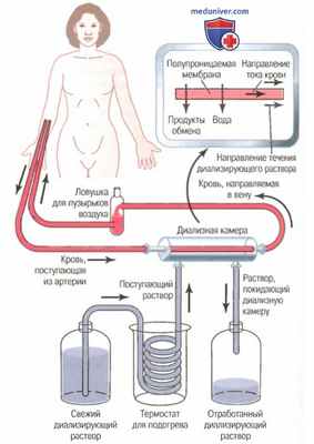Лечение почечной недостаточности - гемодиализ