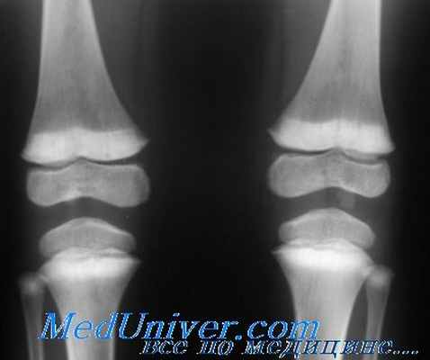 Рахит при синдроме Фанкони