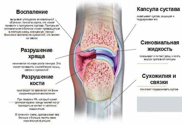 ревматоидный артрит клиническая картина.jpg