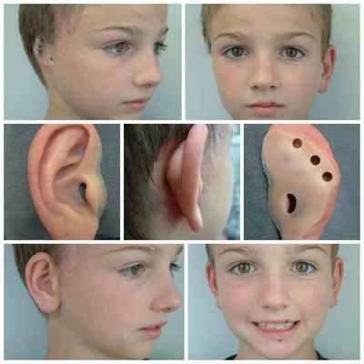 Протезирование ушной раковины