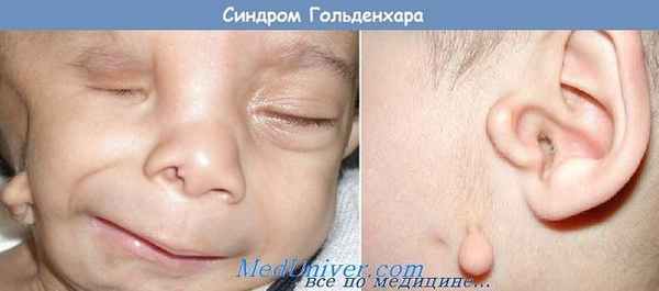 синдрому Гольденхара