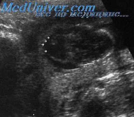 полидактилия у плода