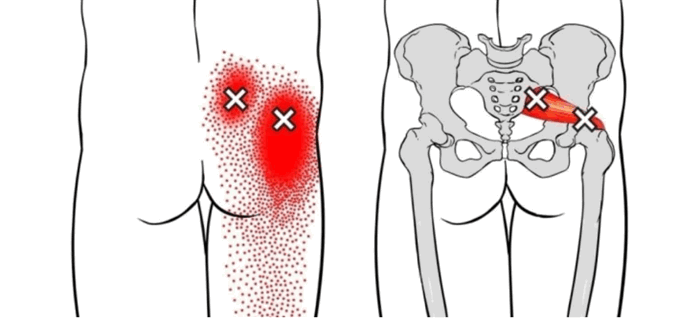 Миофасциальный синдром грушевидной мышцы