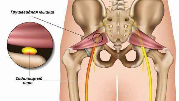 Синдром грушевидной мышцы