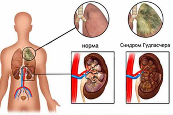 Синдром Гудпасчера
