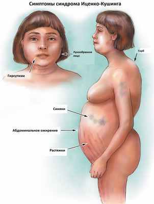 Кушинг_симптомы.jpg