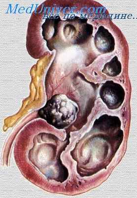 почечнокаменная болезнь