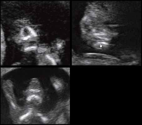 Эхограммы - отсутствие нижнечелюстного промежутка при микрогнатии, при различных синдромах нехромосомного генеза в 11-14 нед беременности