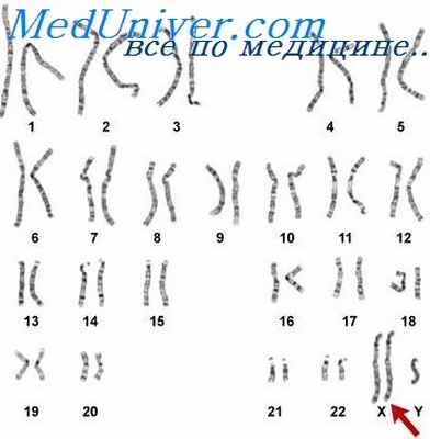 синдром клайнфелтера