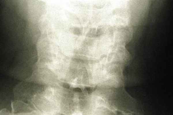 Краниоцервикальные аномалии