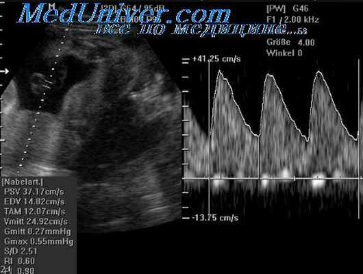 синдром ларсена у плода
