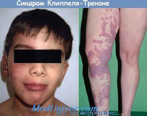 синдром Клиппеля-Треноне