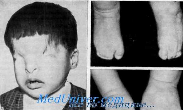 синдром криптофтальмии