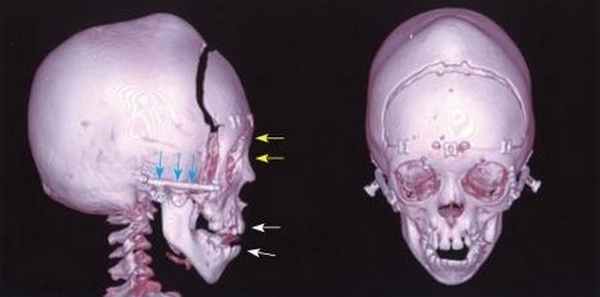 Черепно-лицевой дизостоз