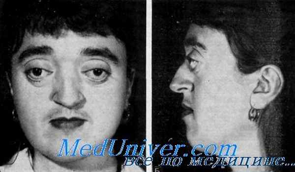 синдром крузона