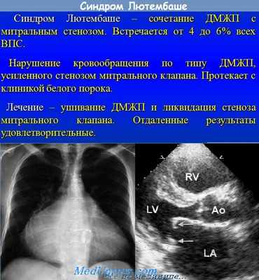 синдром Лютембаше
