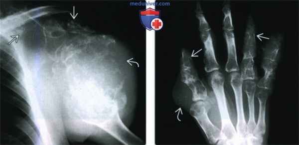 Синдром Мафуччи - лучевая диагностика