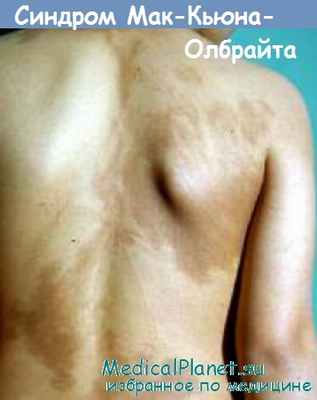 синдром Мак-Кьюна-Олбрайта