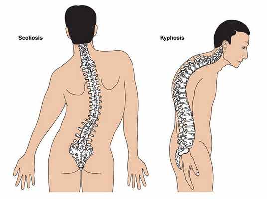 Сколиоз и кифоз