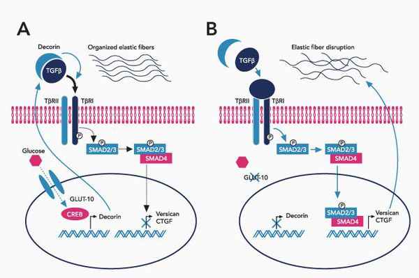 Нарушение эластических фибрилл соединительной ткани