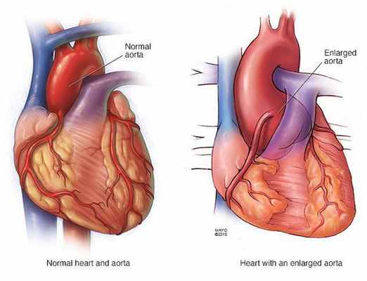 Порок аорты