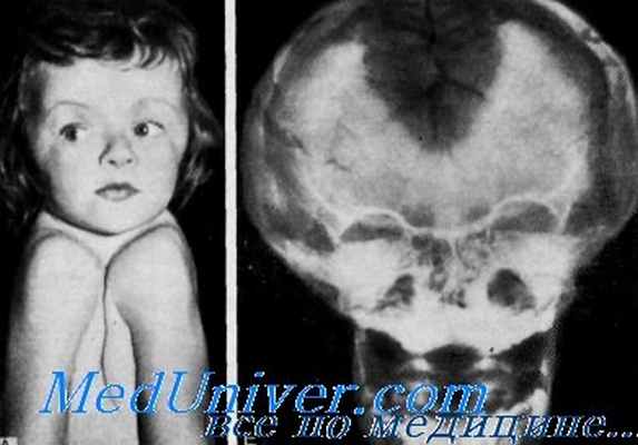 ключично-черепная дисплазия