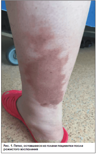 Рис. 1. Пятно, оставшееся на голени пациентки после рожистого воспаления