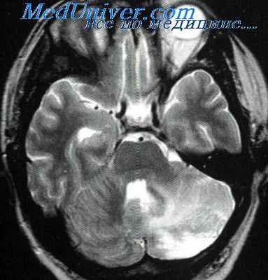 синдром мебиуса