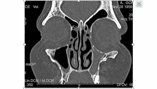 Синдром молчащего синуса