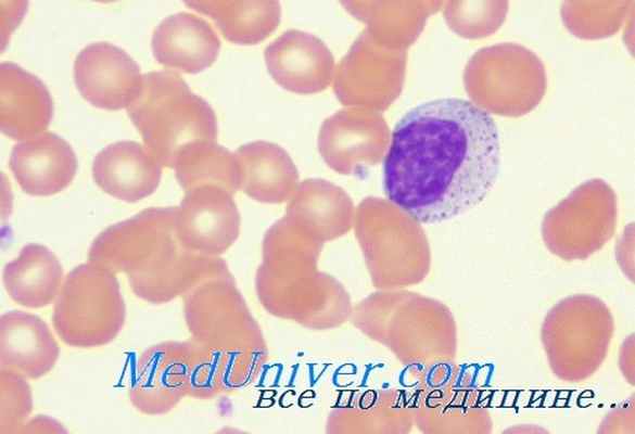 синдром оменна