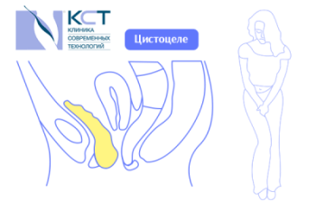 Недержание мочи - частый симптом опущения тазовых органов, цистоцеле