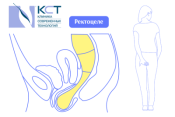Недержание кала и запоры - частый симптом опущения тазовых органов, ректоцеле