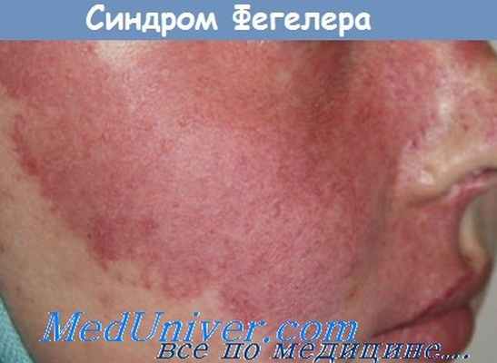 синдром Фегелера