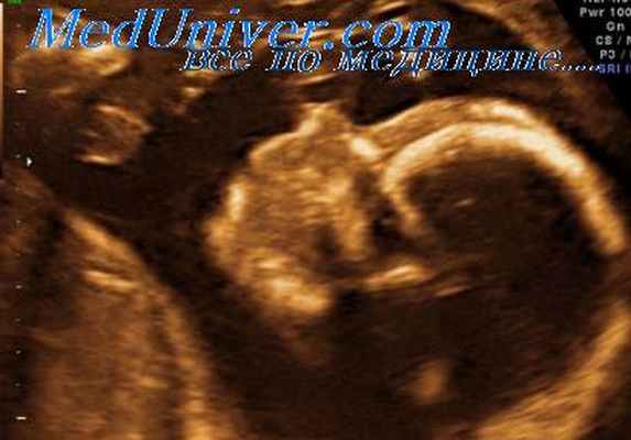 синдром пена-шокейра