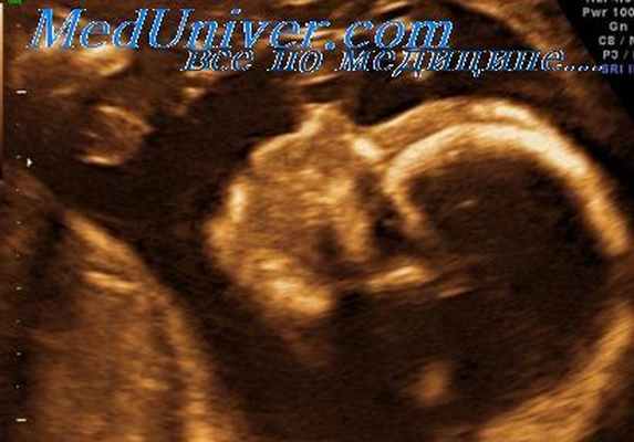 синдром пена-шокейра