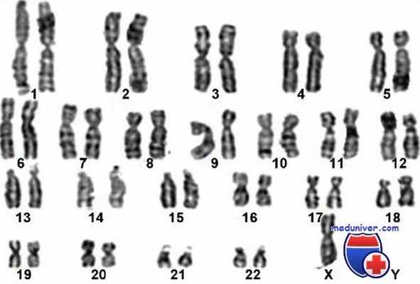 дисгенезия гонад