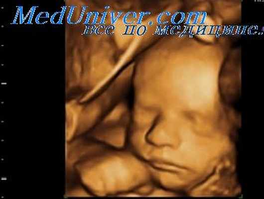 синдром поланда