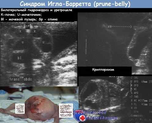 Синдром Игла—Барретта