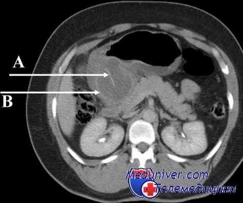 синдром приводящей петли