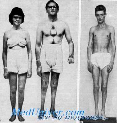 синдром рефсума