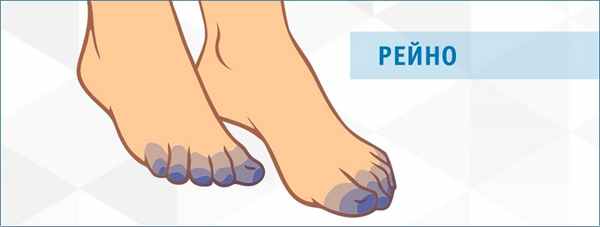 Болезнь и синдром Рейно